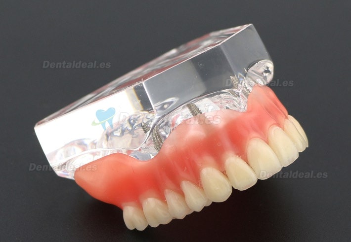 Dental Study Teeth Model Overdenture Superior With 4 Implants Demo Model 6001